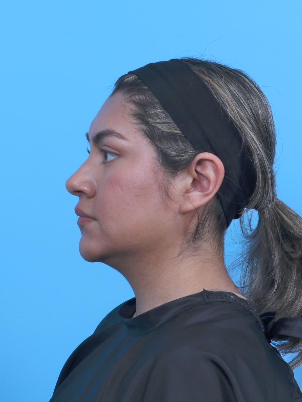 Rhinoplasty case #6066 before