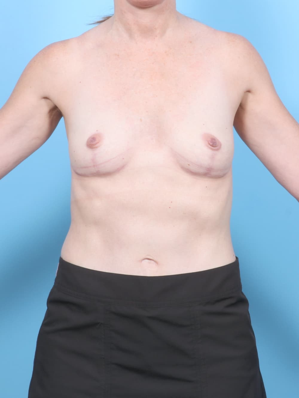 Breast Implant Removal with Lift case #7096 after