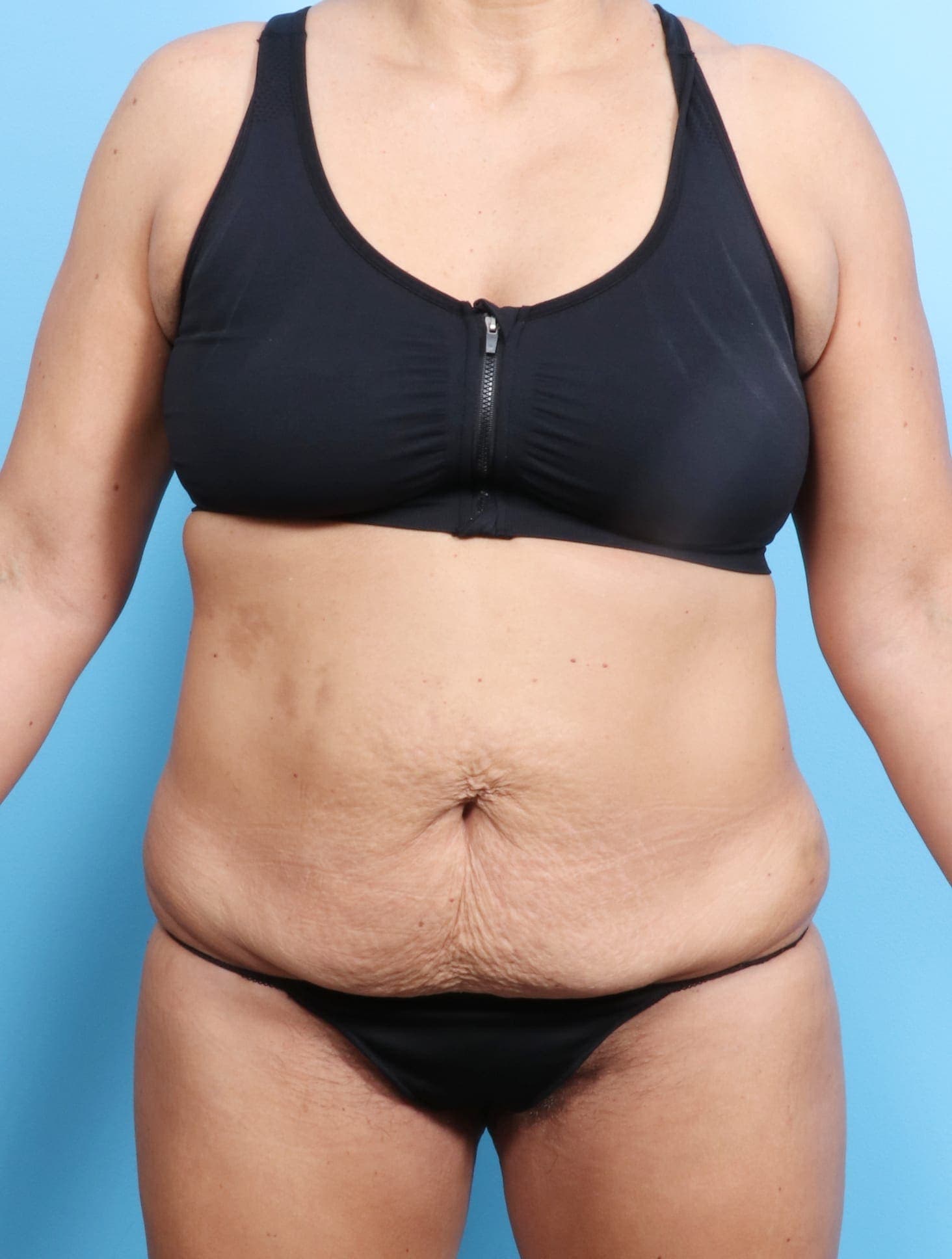 Tummy Tuck case #1675 before, image 1