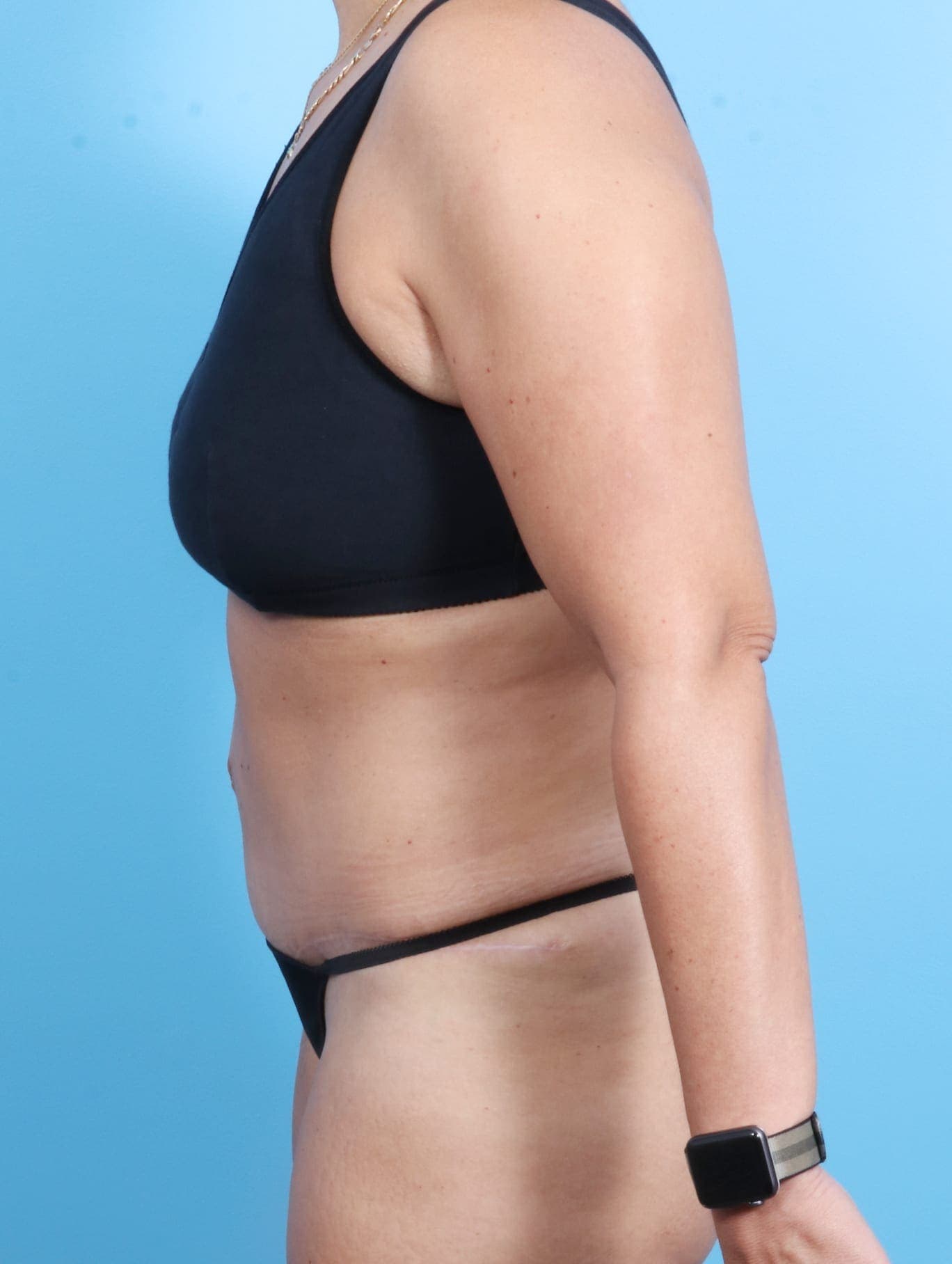 Tummy Tuck case #1675 after, image 3
