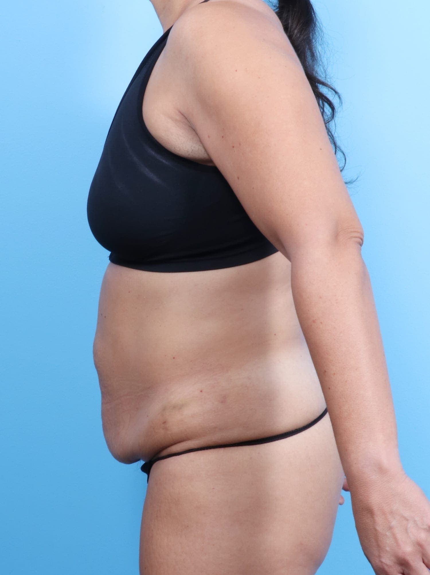 Tummy Tuck case #1675 before, image 3