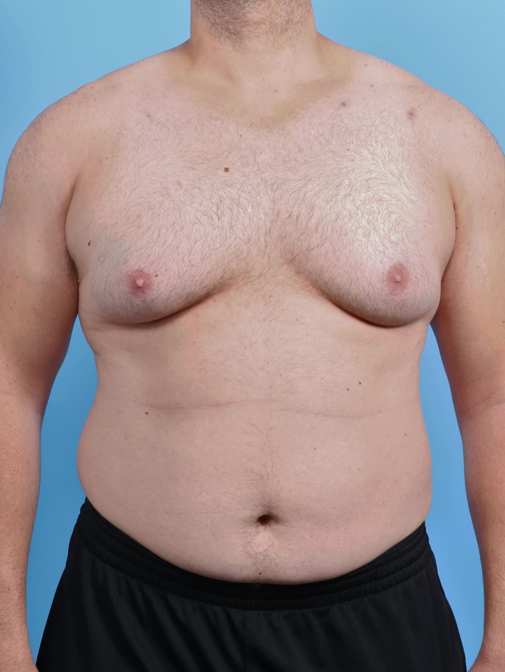 Male Breast Reduction case #5042 before