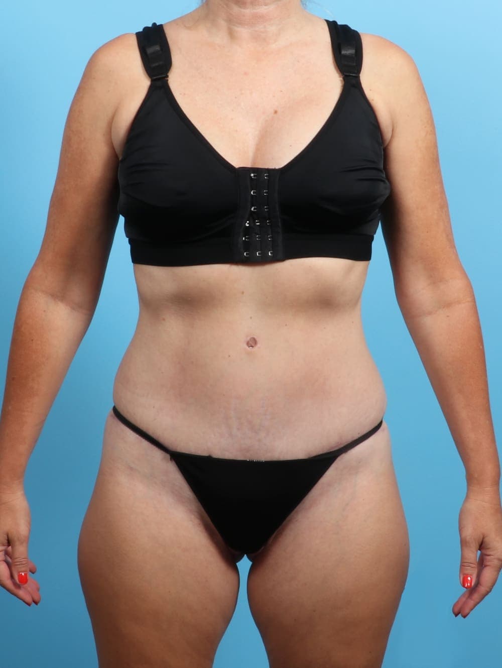 Tummy Tuck case #2703 after, image 1