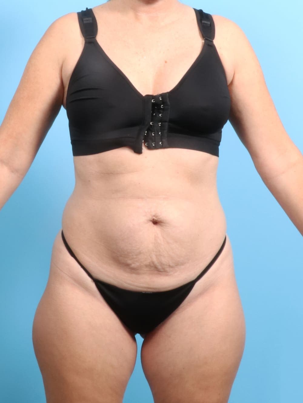 Tummy Tuck case #2703 before, image 1