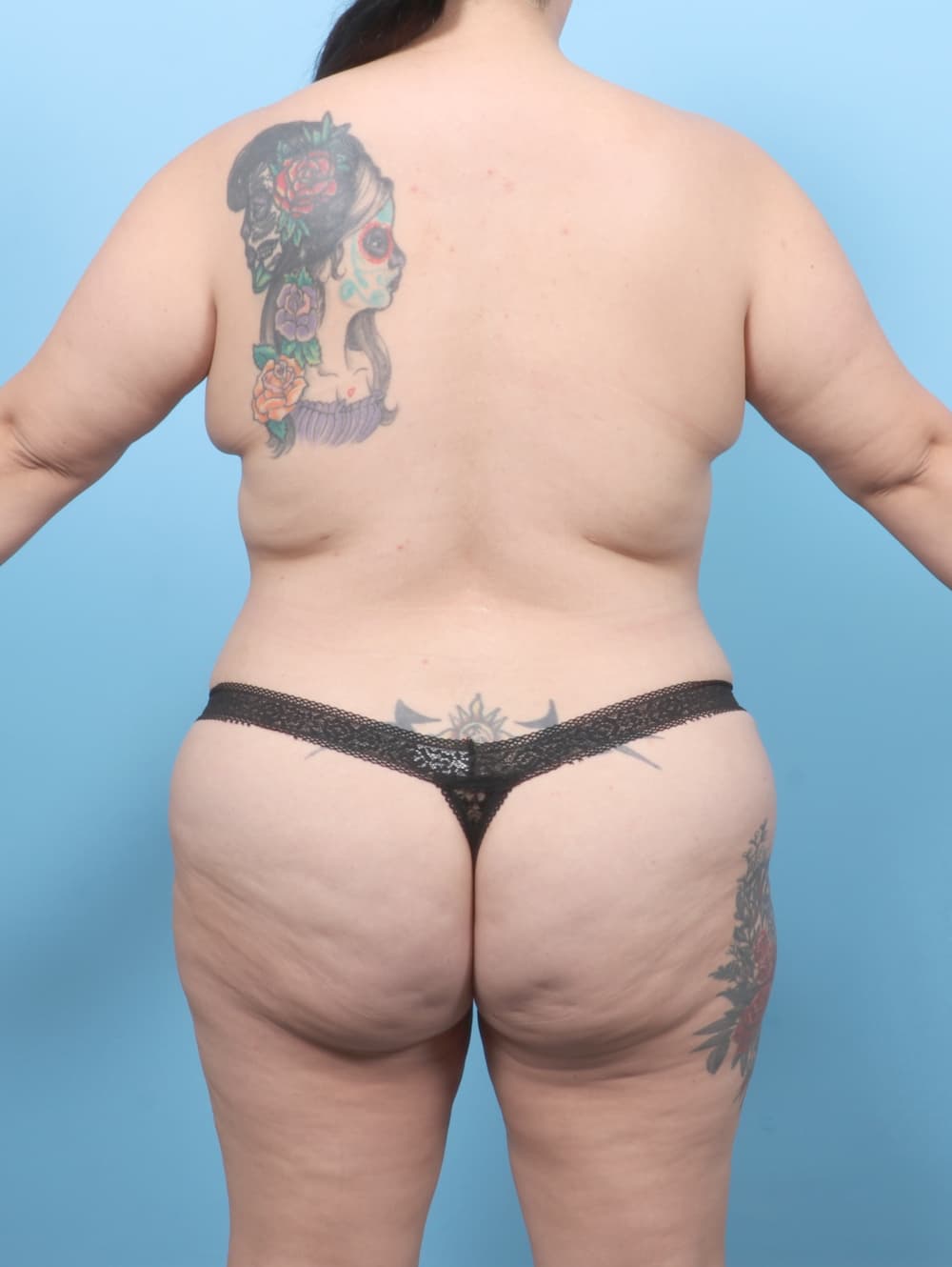 Liposuction case #7905 after, image 4