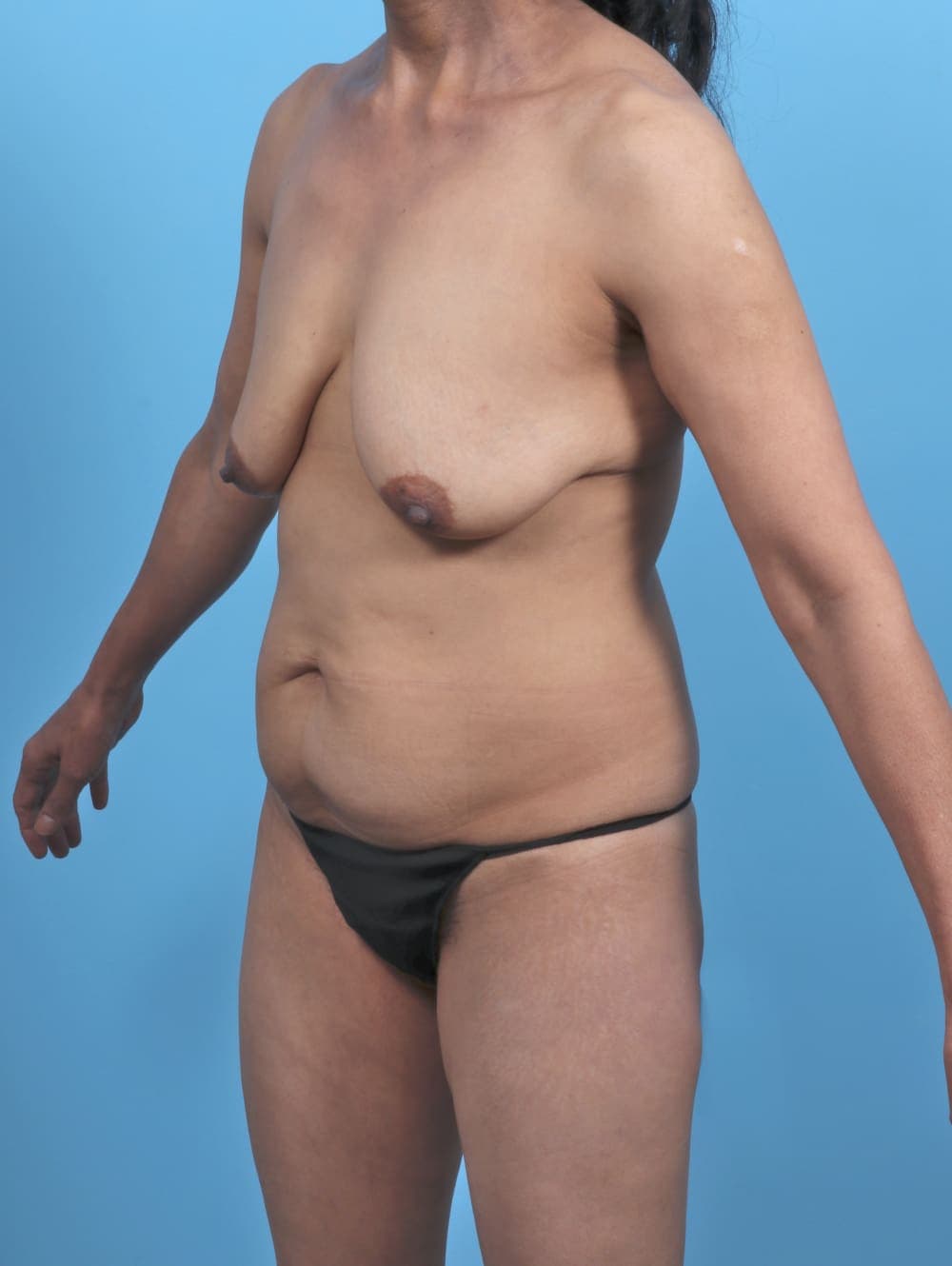 Mommy Makeover case #5490 before, image 2