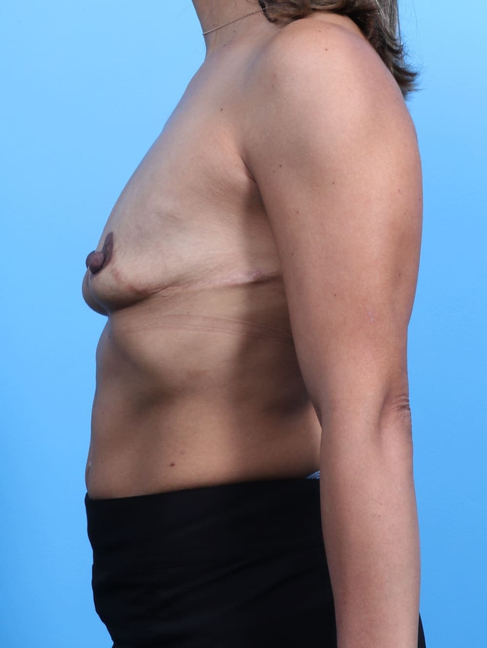 Breast Augmentation case #3185 before, image 3