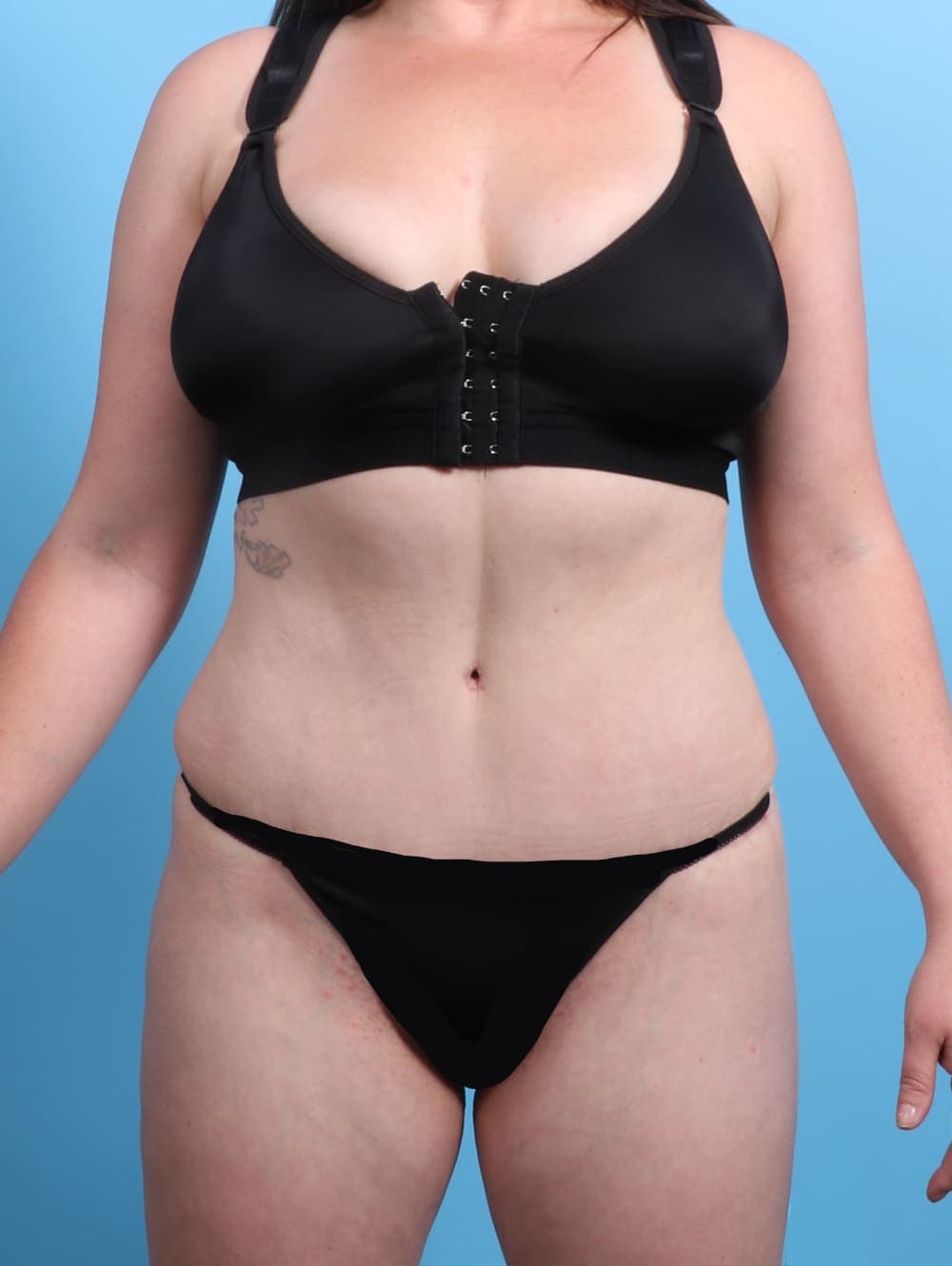 Tummy Tuck case #2370 after, image 1