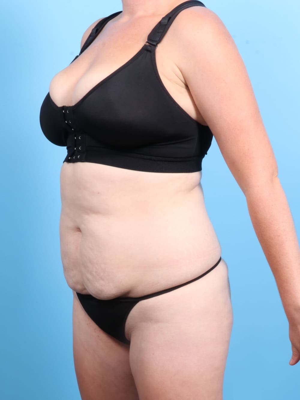 Tummy Tuck case #2370 before, image 2