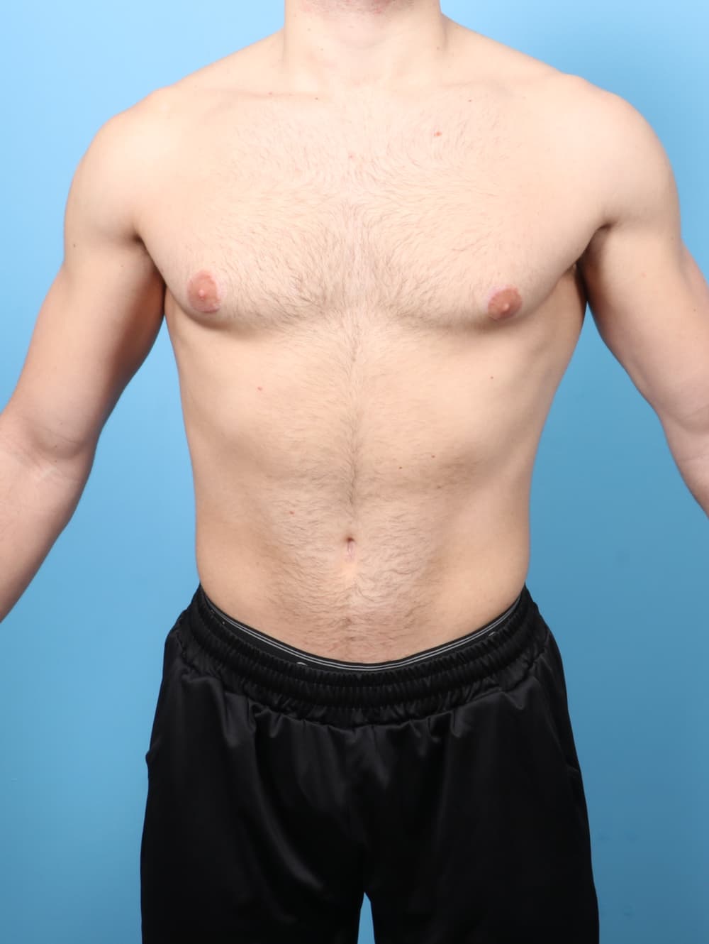 Male Breast Reduction case #8800 after, image 1