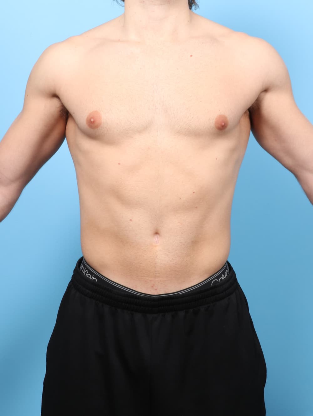 Male Breast Reduction case #8800 before, image 1