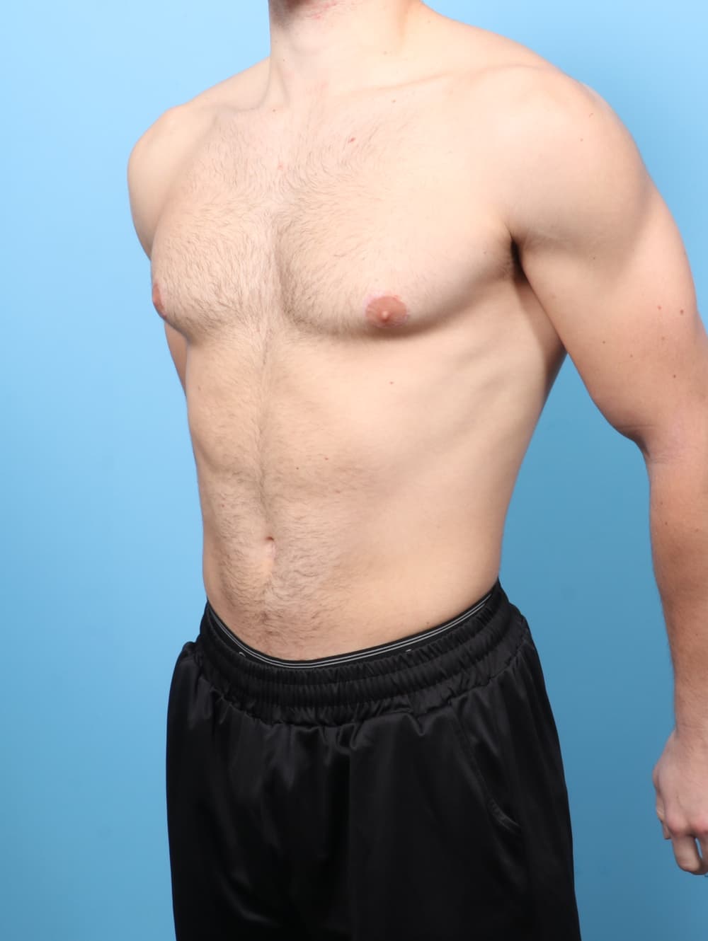 Male Breast Reduction case #8800 after, image 2