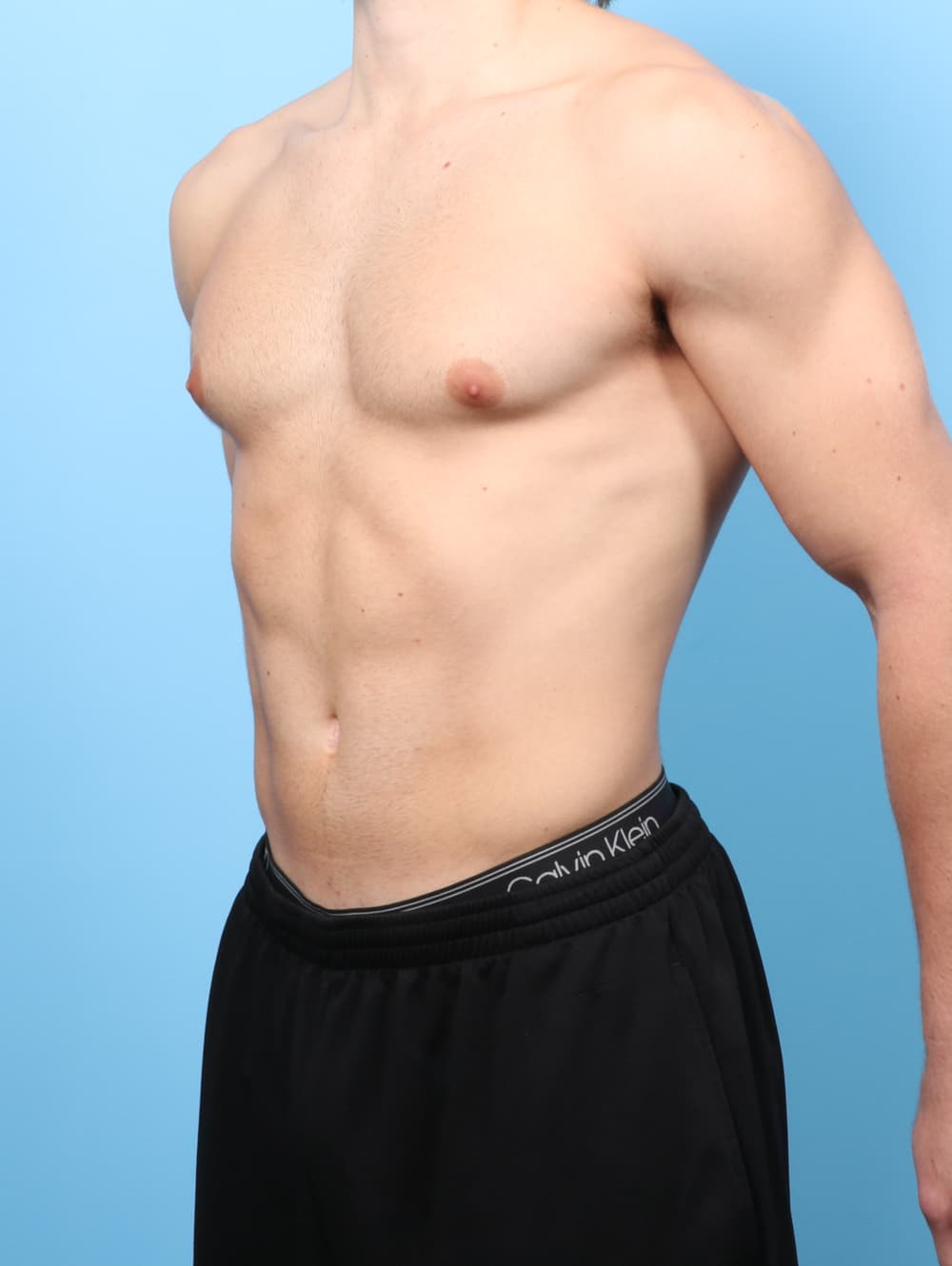 Male Breast Reduction case #8800 before, image 2