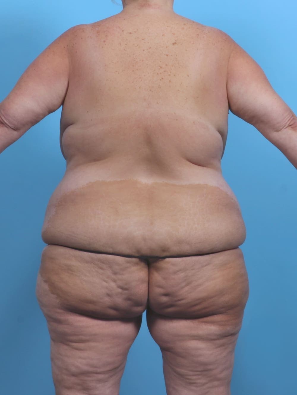 Breast Lift/Reduction case #5694 before, image 2