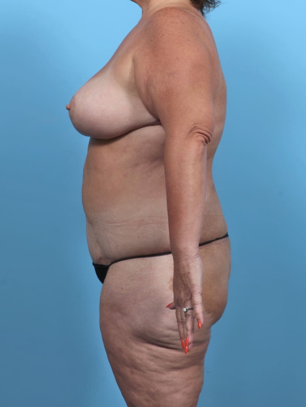 Breast Lift/Reduction case #5694 after, image 4