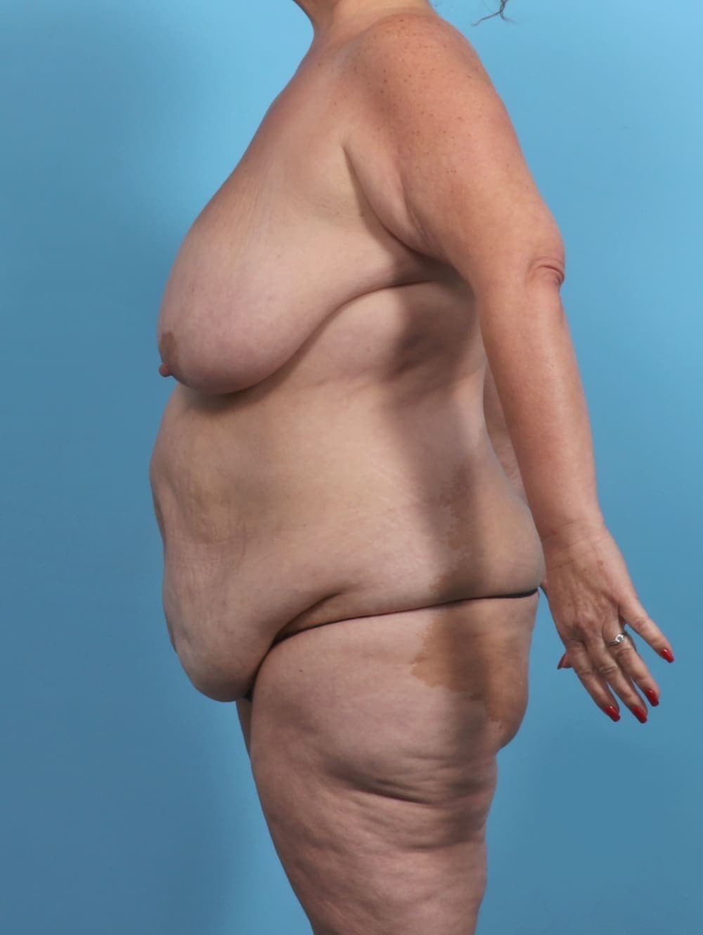 Breast Lift/Reduction case #5694 before, image 4