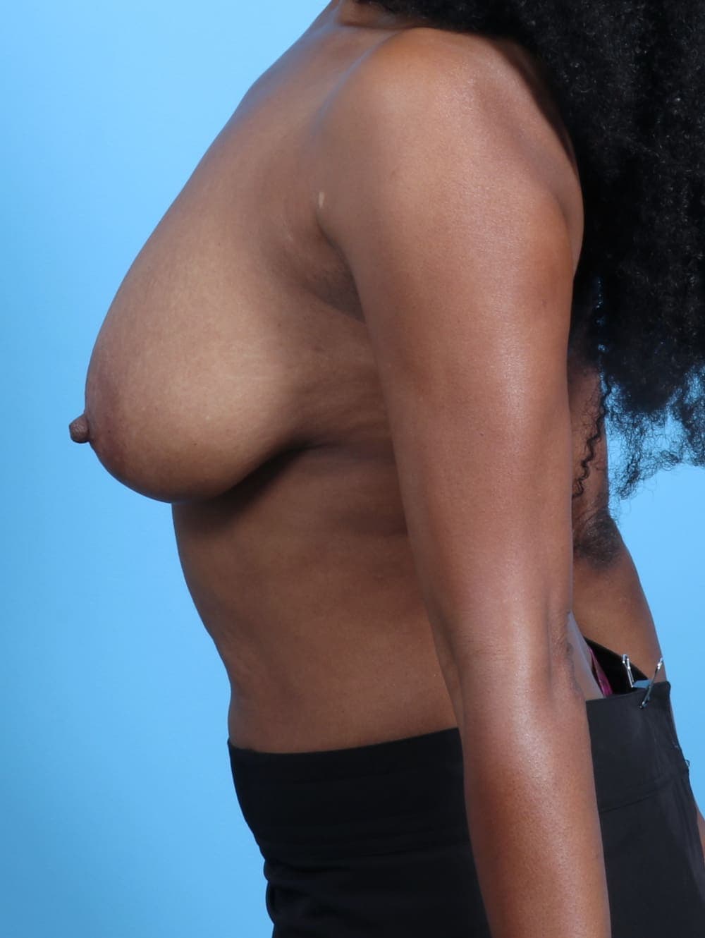 Breast Lift/Reduction case #3460 before, image 3