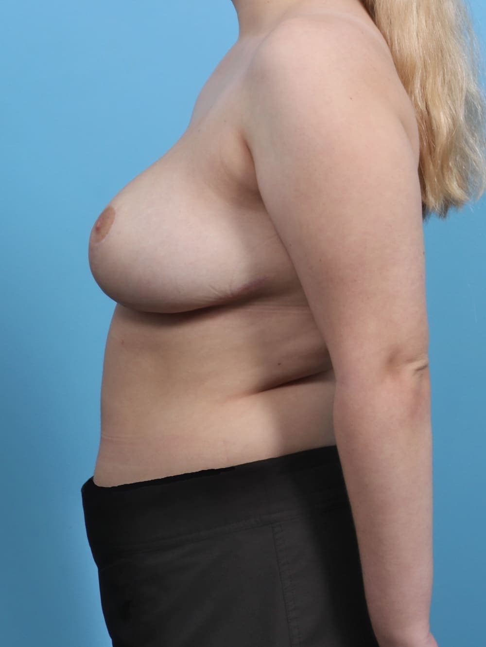 Breast Lift/Reduction case #4065 after, image 3