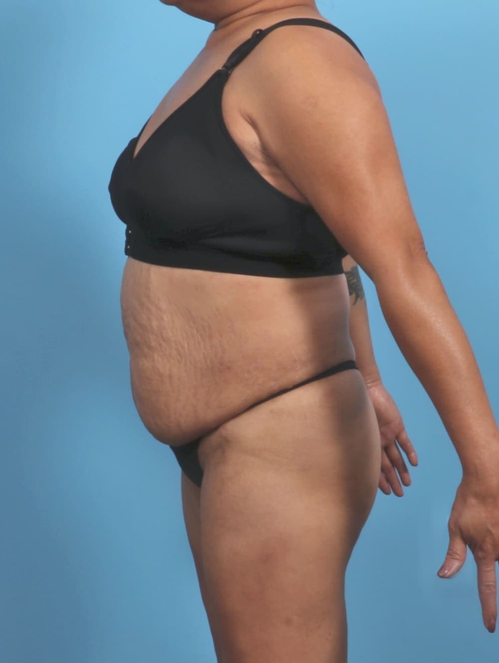 Liposuction case #5676 before, image 4