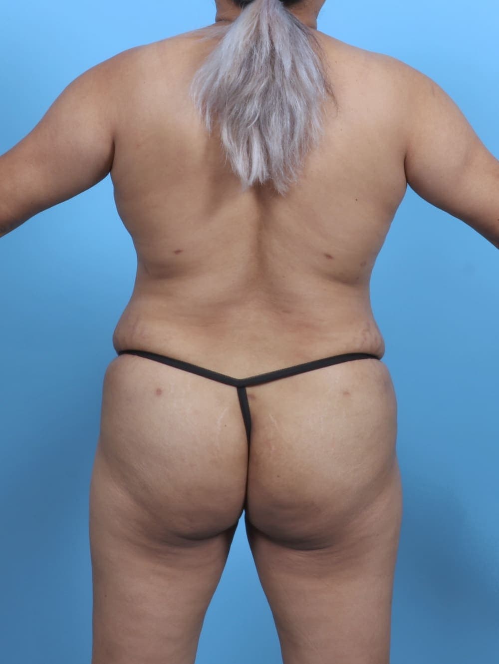 Liposuction case #5676 after, image 2