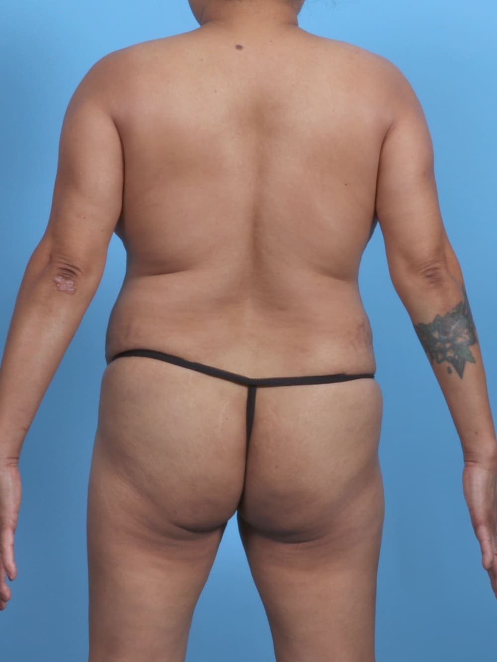 Liposuction case #5676 before, image 2