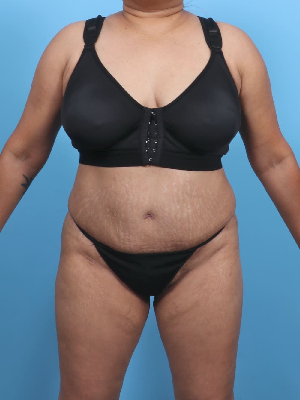 Liposuction case #5676 after, image 1