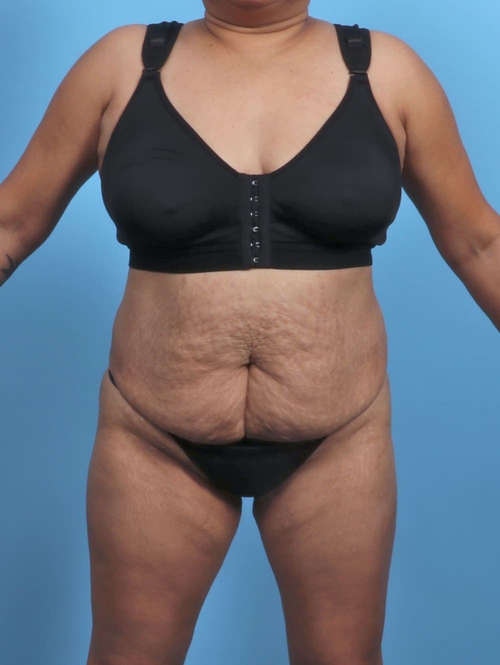 Liposuction case #5676 before, image 1