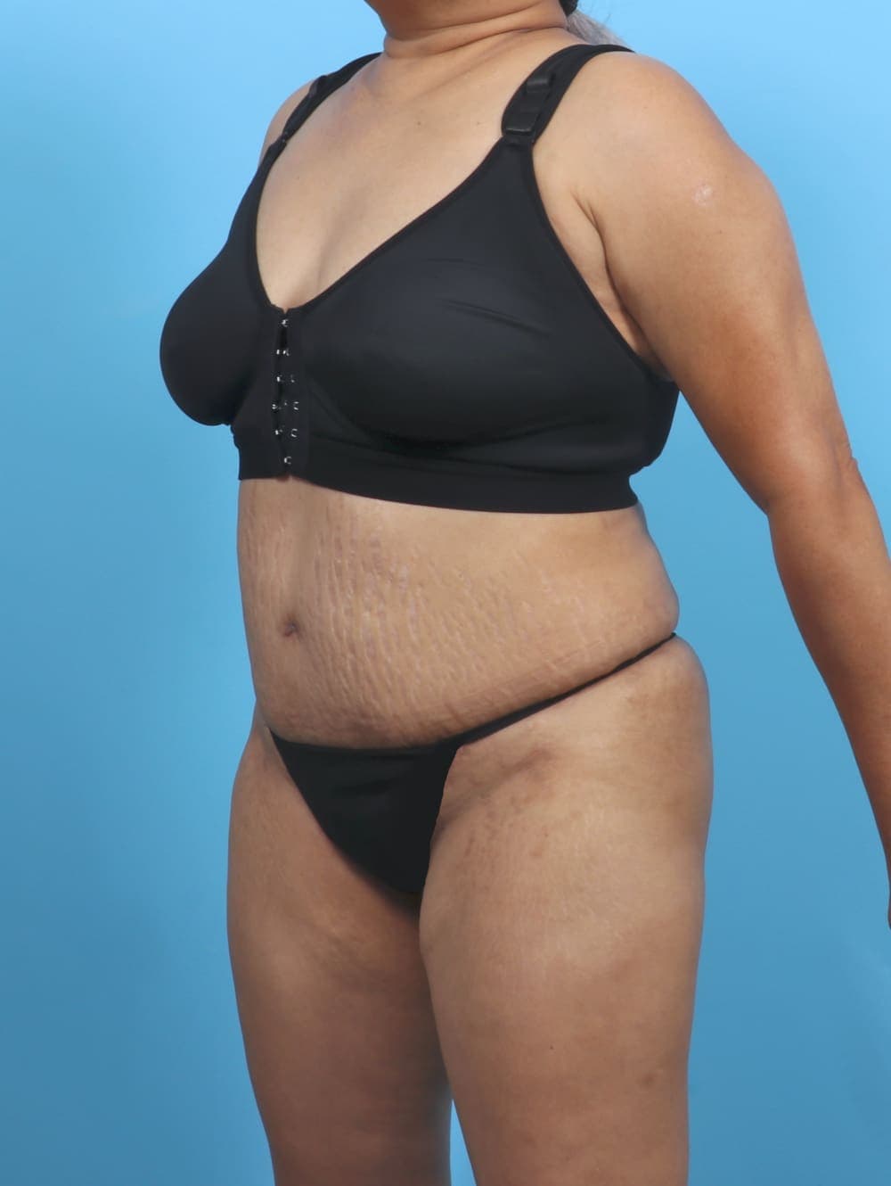Liposuction case #5676 after, image 3