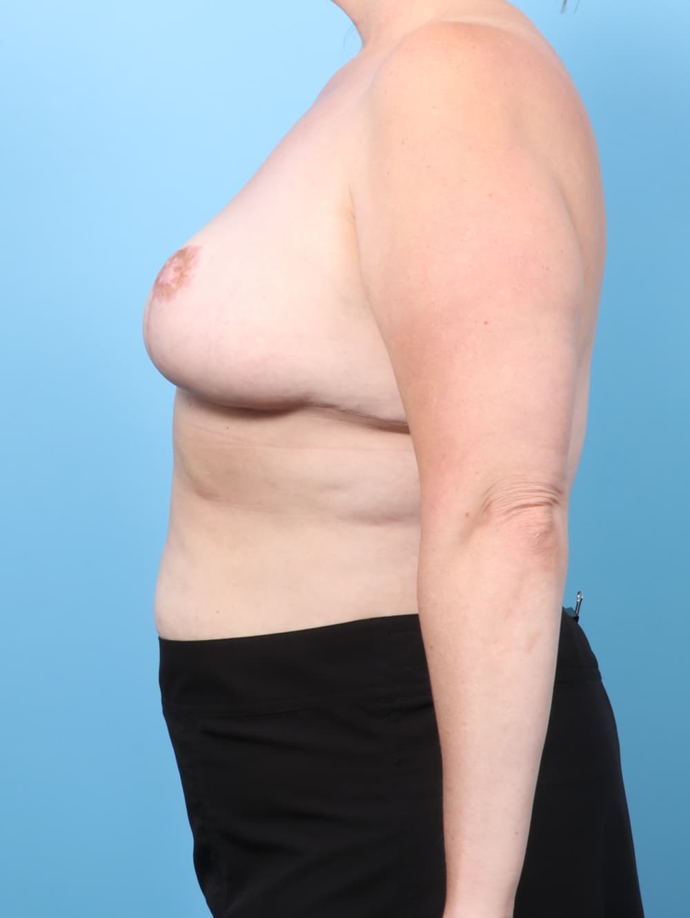 Liposuction case #8618 after, image 3