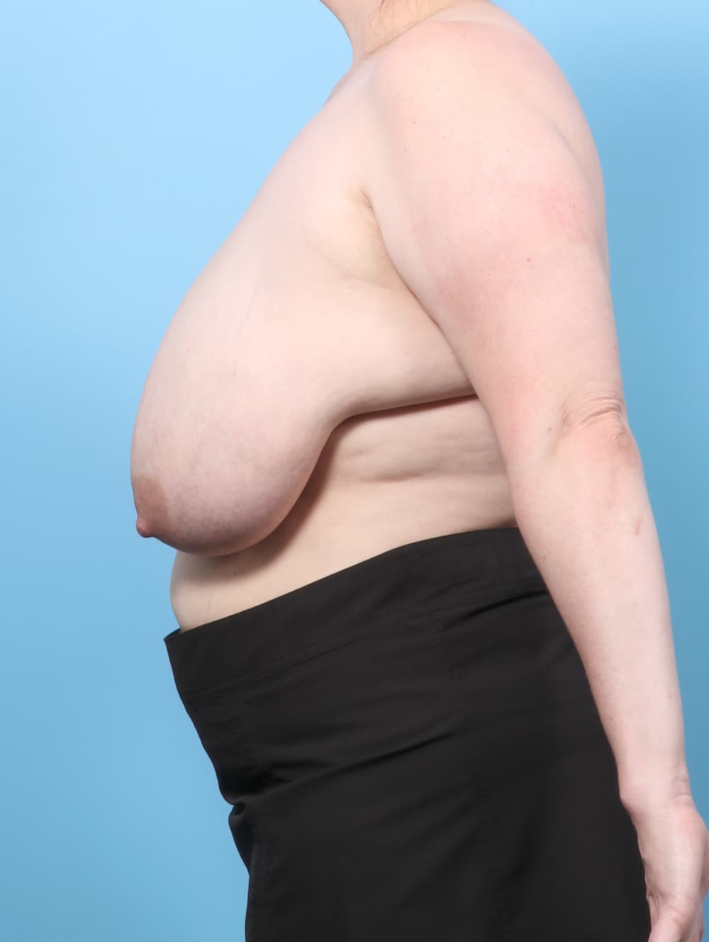 Liposuction case #8618 before, image 3