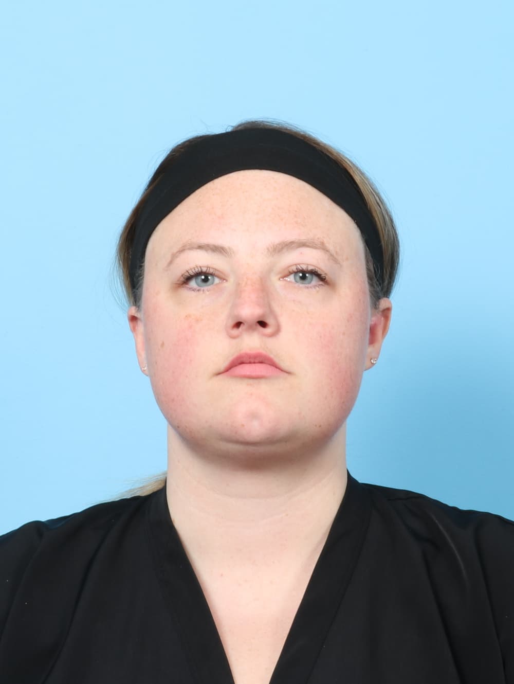 Facial Liposuction case #7642 after, image 1