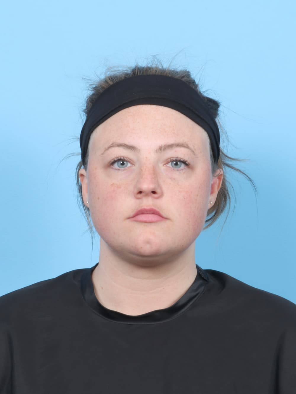 Facial Liposuction case #7642 before, image 1