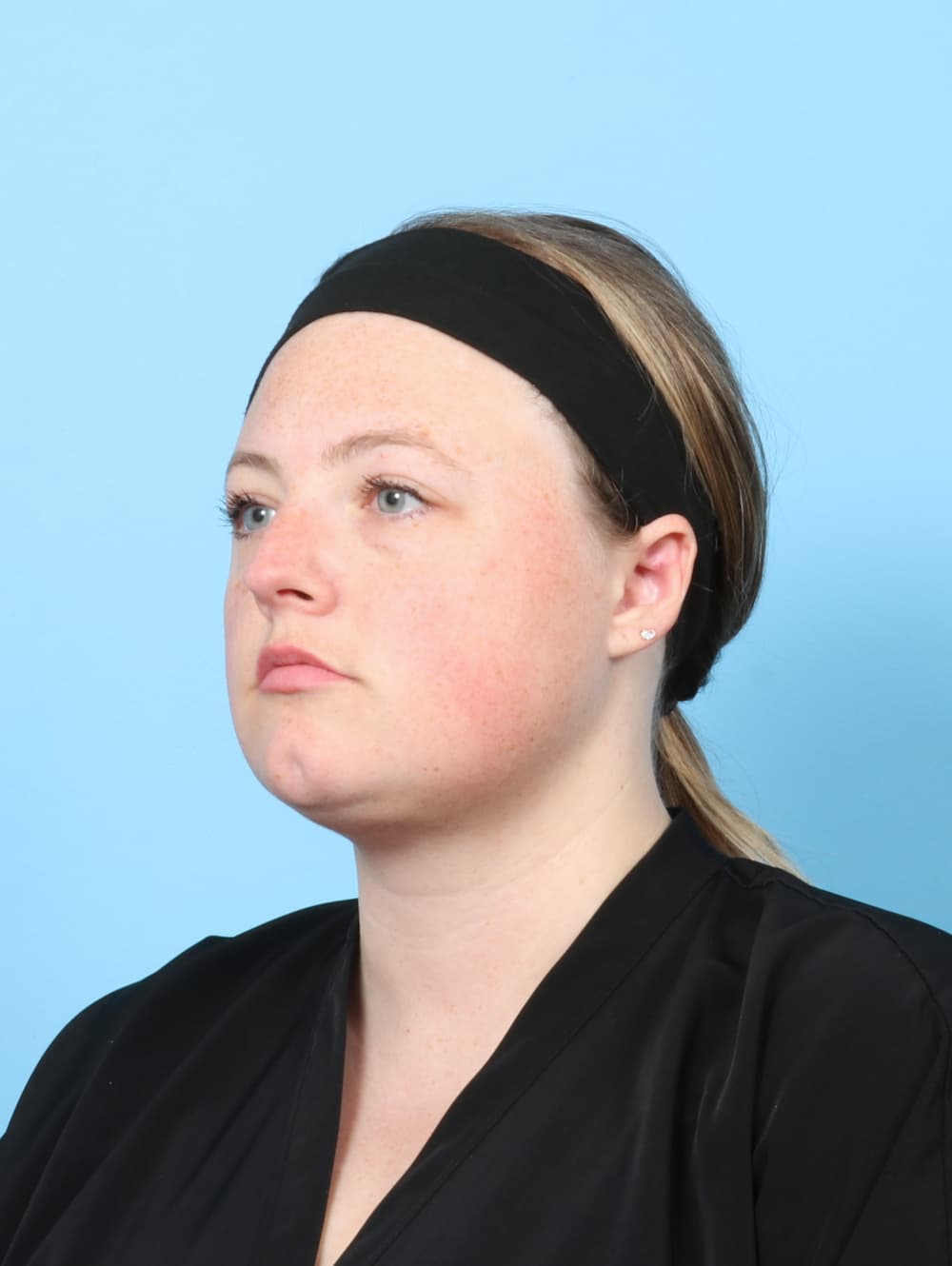 Facial Liposuction case #7642 after, image 2