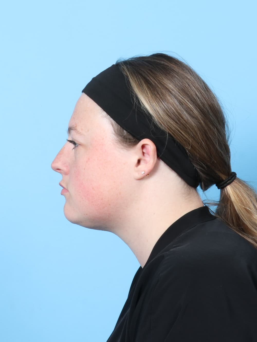 Facial Liposuction case #7642 after, image 3
