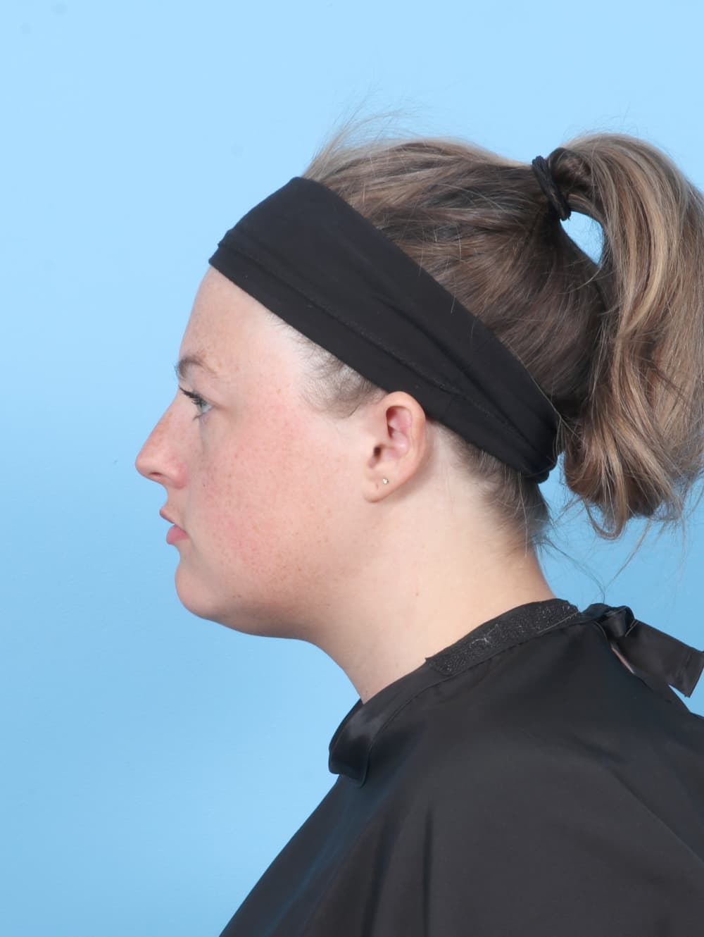 Facial Liposuction case #7642 before, image 3