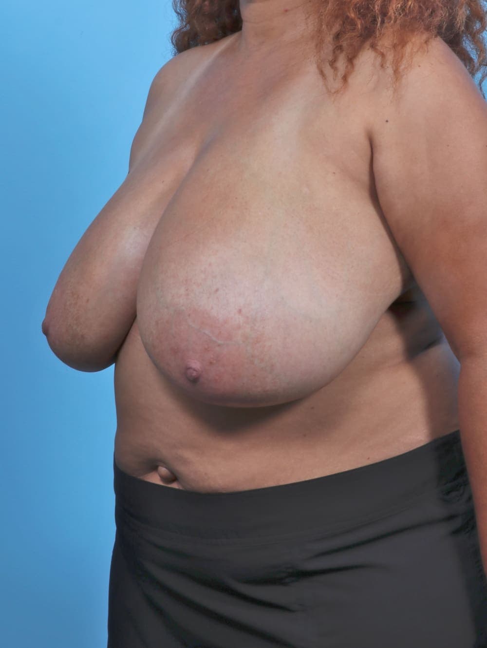 Breast Lift/Reduction case #4850 before, image 2