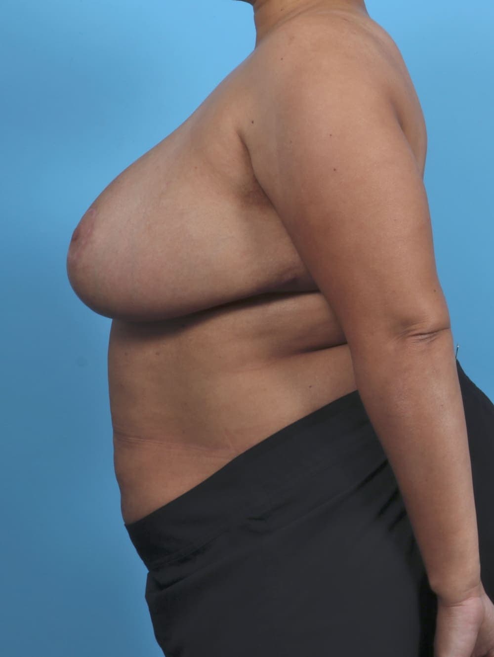 Breast Lift/Reduction case #4850 after, image 3