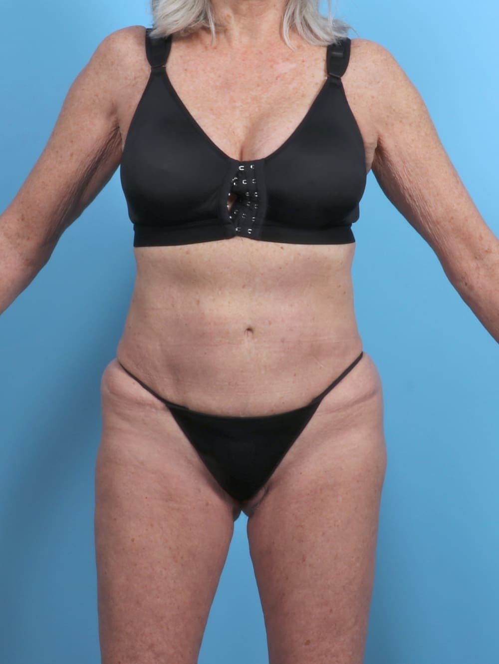 Tummy Tuck case #5576 before, image 1