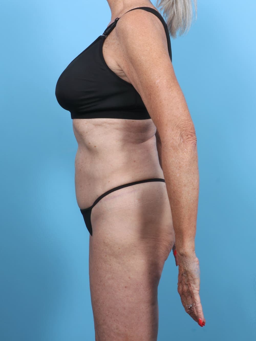 Tummy Tuck case #5576 after, image 3