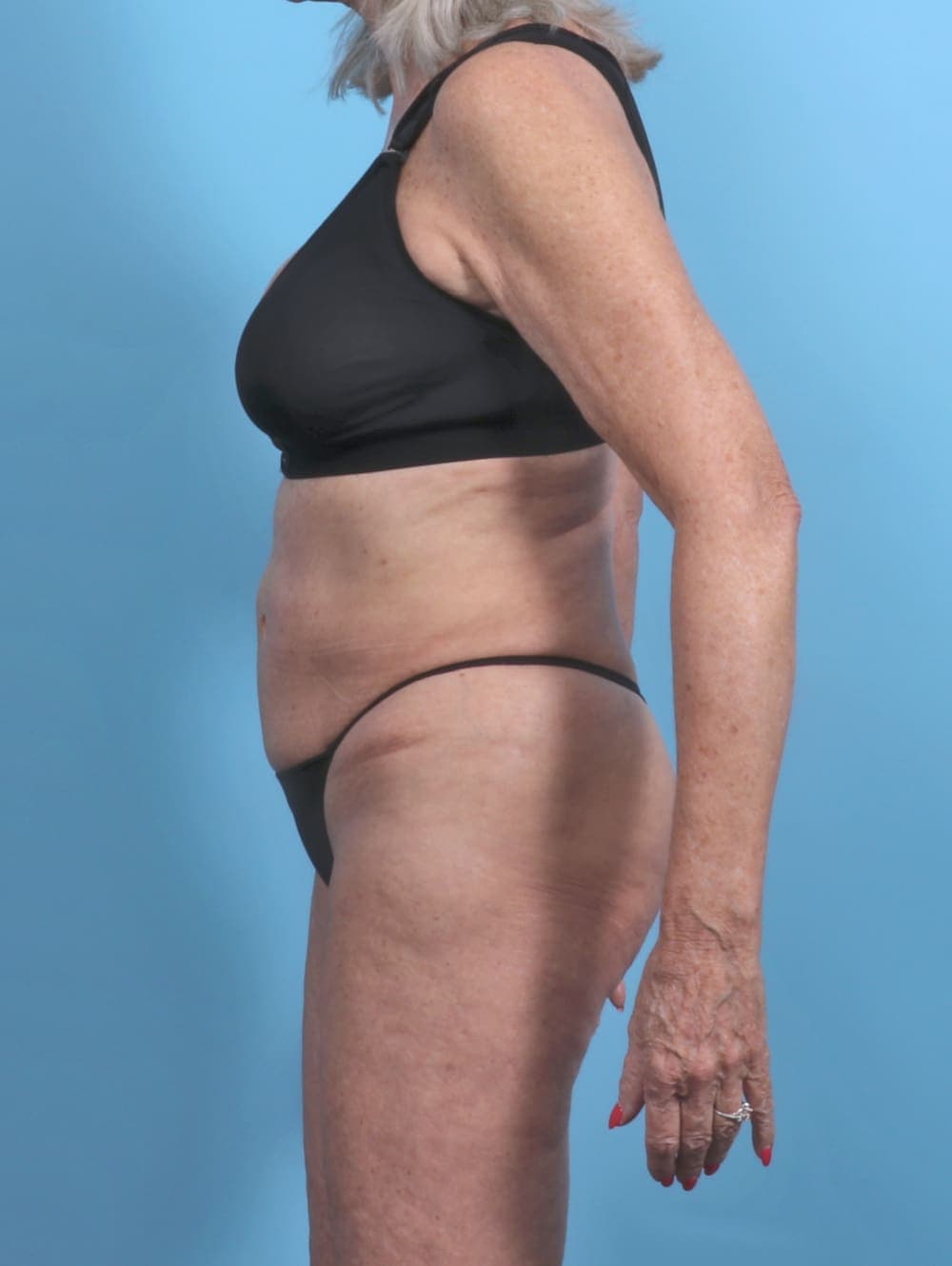 Tummy Tuck case #5576 before, image 3