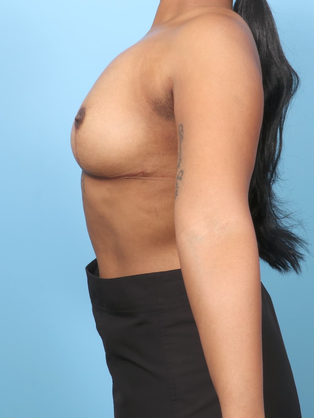 Breast Implant Revision case #8690 after, image 3