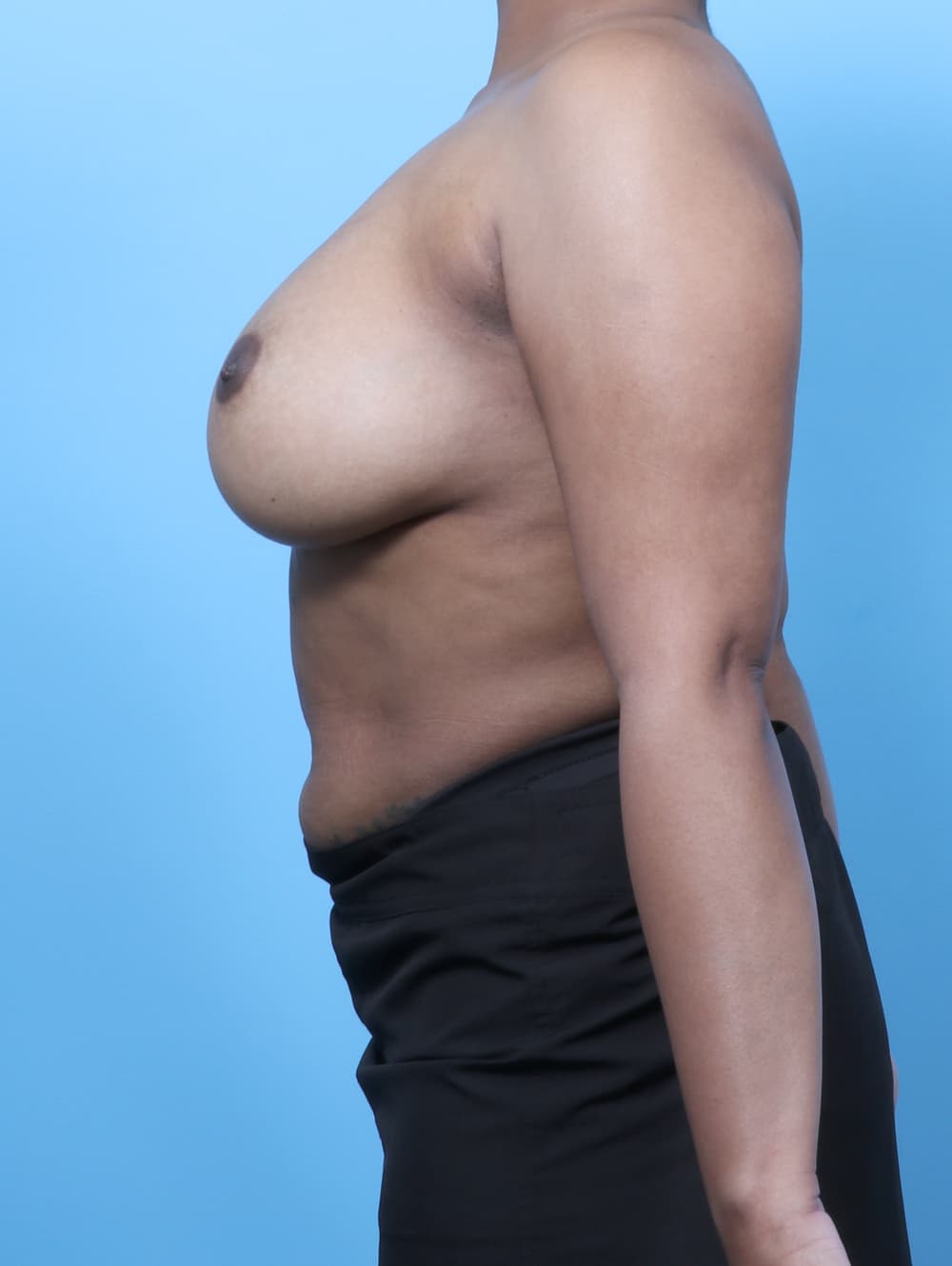 Breast Implant Revision case #8690 before, image 3