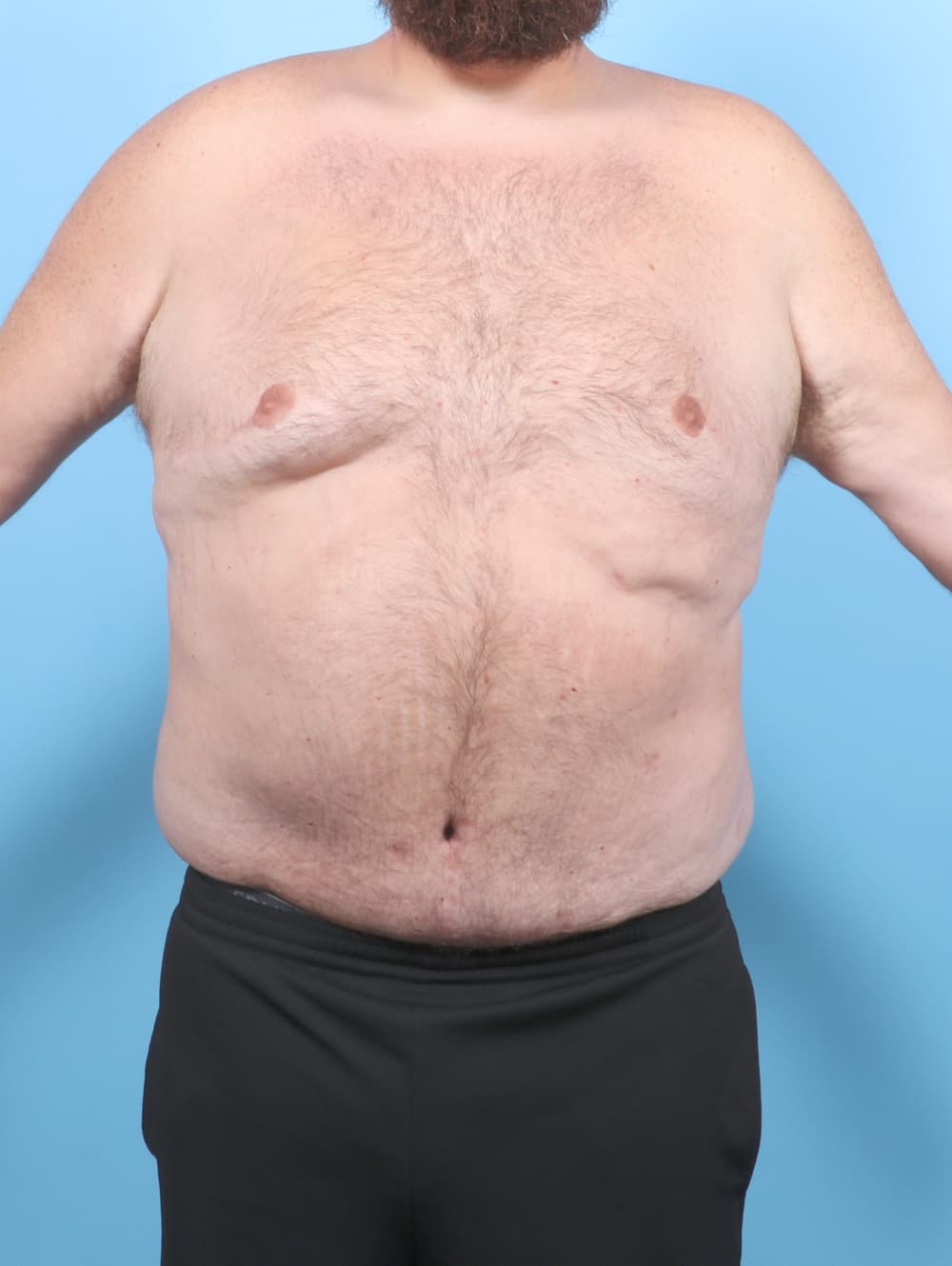 Tummy Tuck case #7122 after, image 1