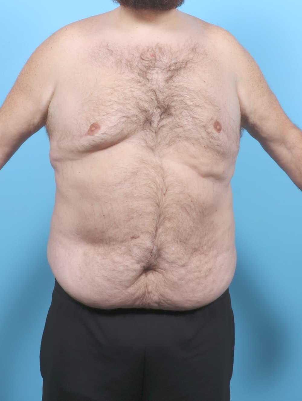 Tummy Tuck case #7122 before, image 1