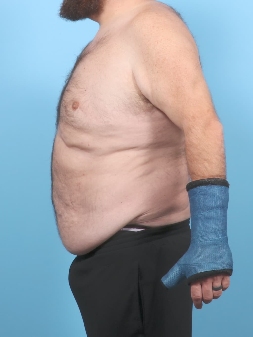 Tummy Tuck case #7122 before, image 3