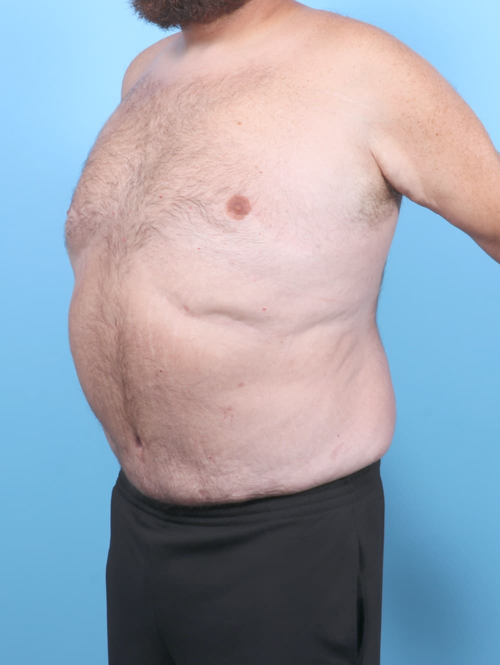 Tummy Tuck case #7122 after, image 2