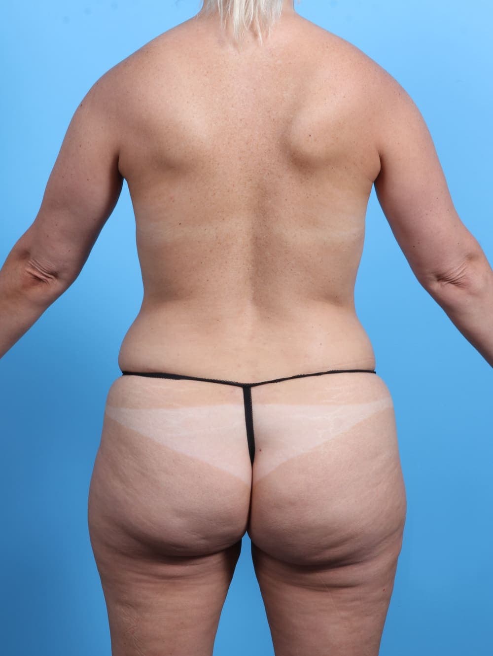 Mommy Makeover case #3211 before, image 1