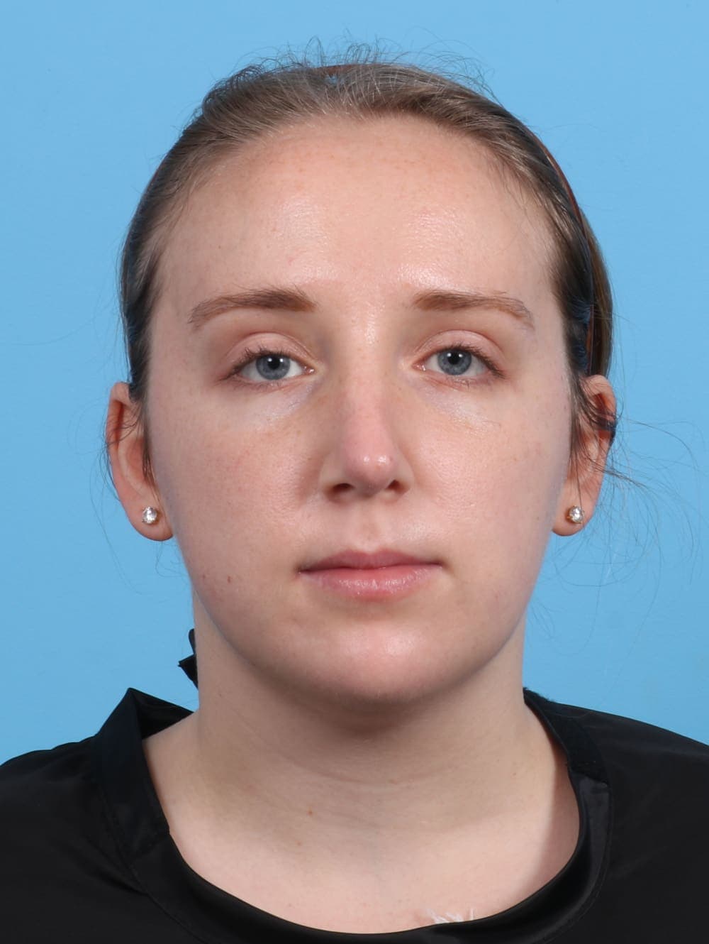 Rhinoplasty case #3486 after, image 2