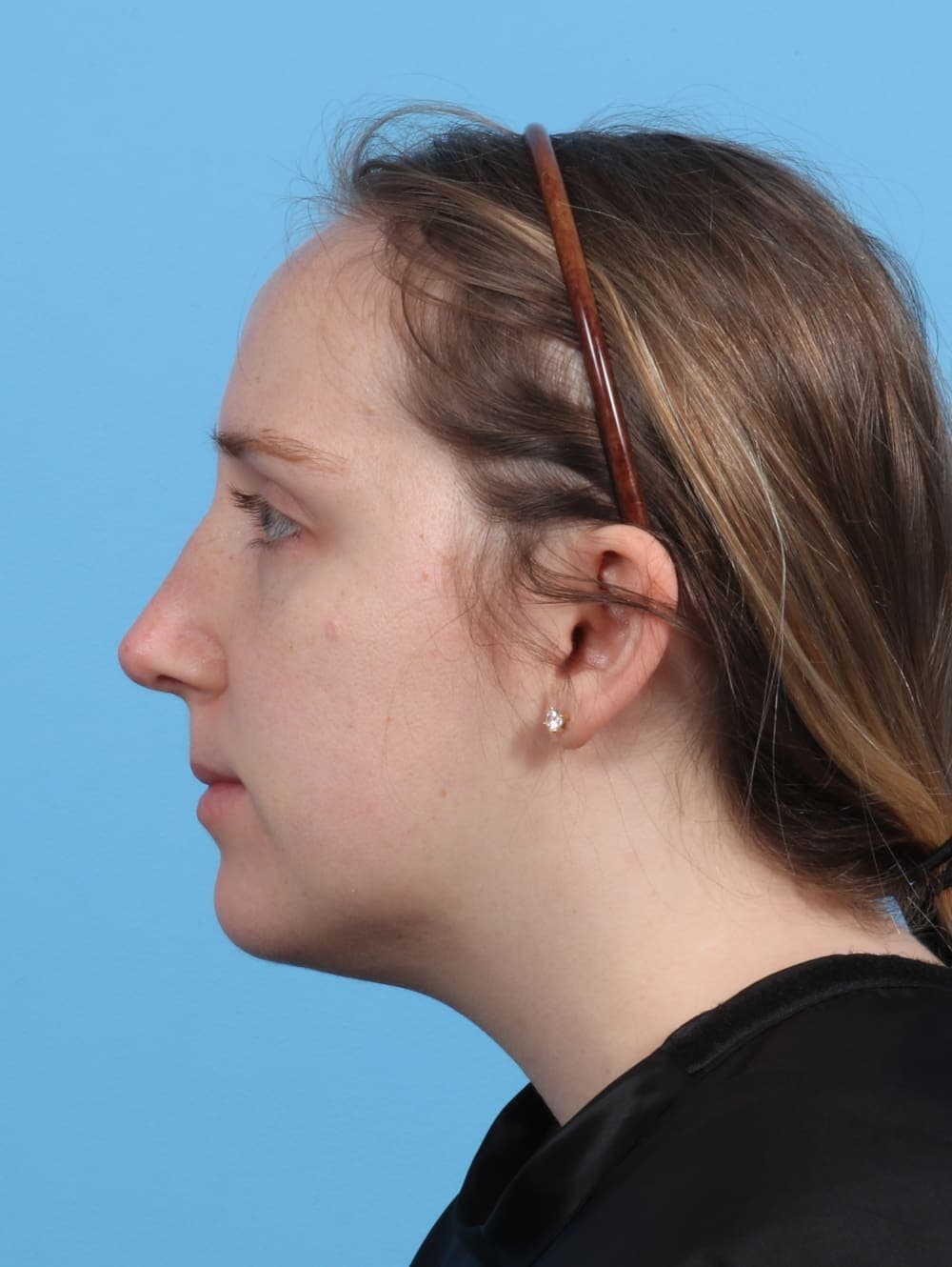 Rhinoplasty case #3486 after