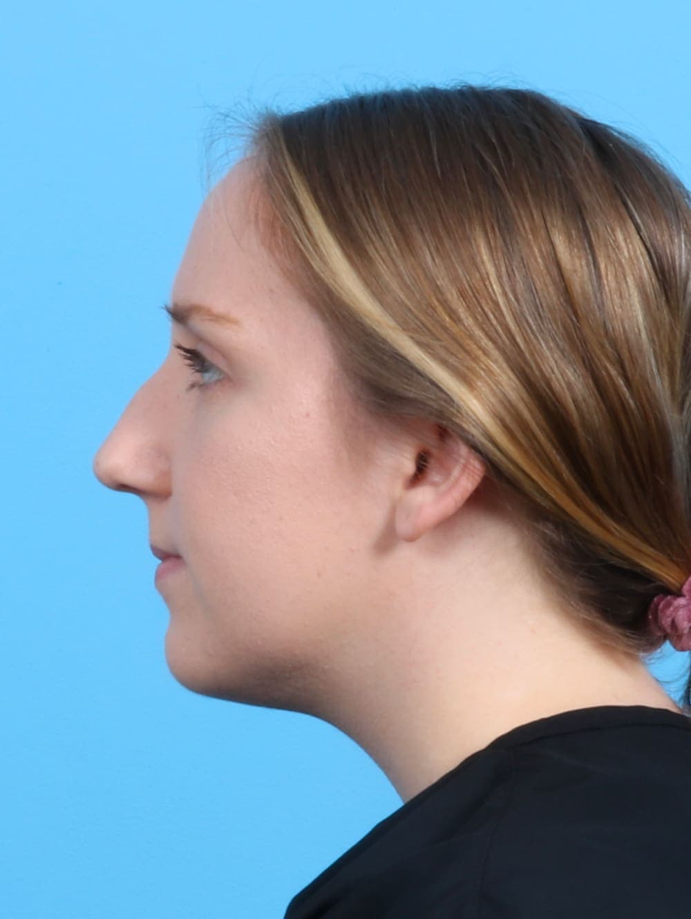 Rhinoplasty case #3486 before